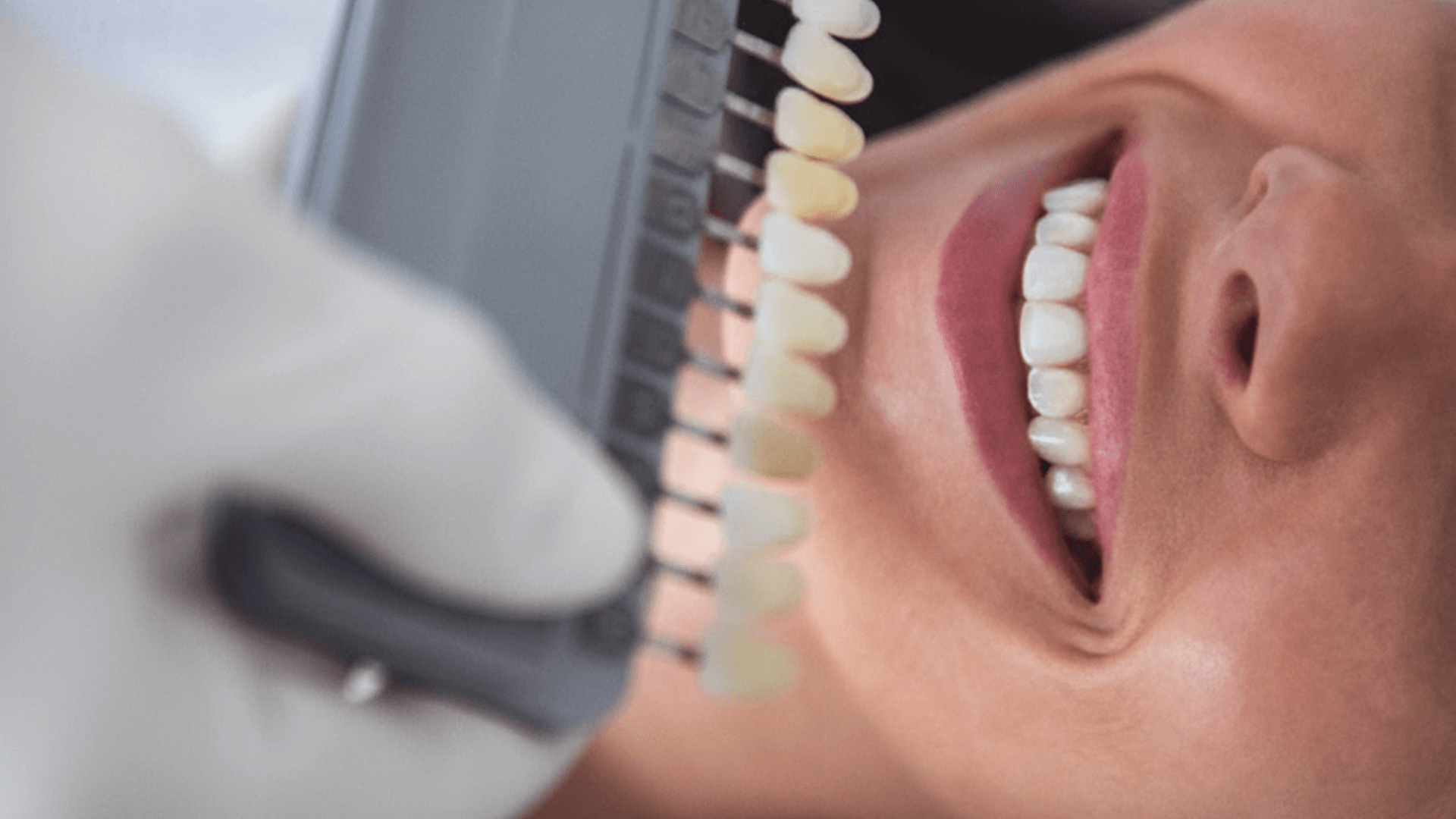 Branqueamento Dentário: a solução eficaz para dentes manchados ou amarelados