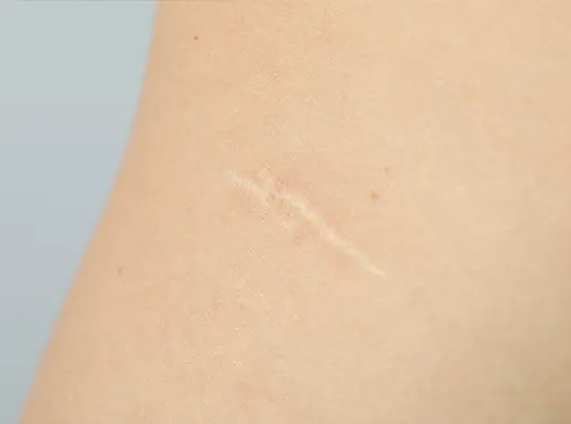 Queloides e cicatrizes