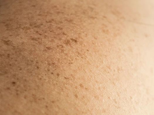Manchas e Melasma